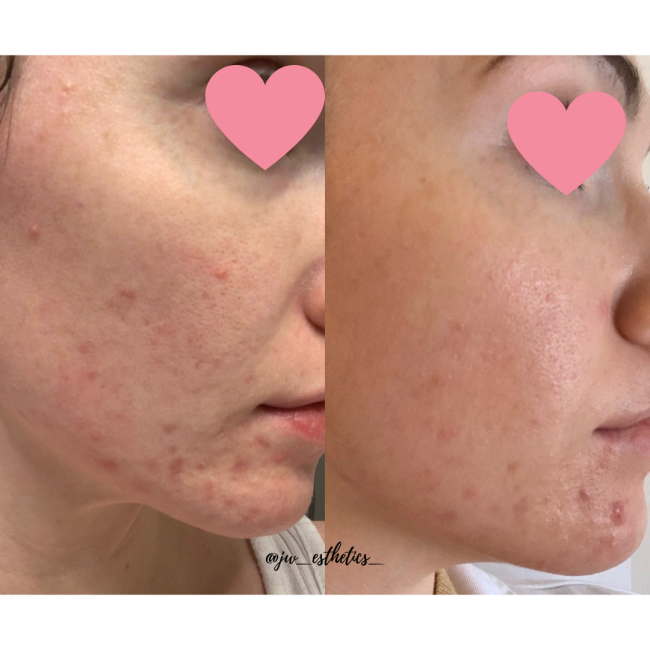 Before and After Acne Treatment