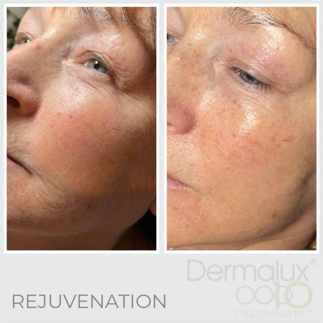 facial