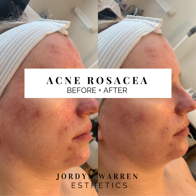 Before and After Acne Rosacea Treatment
