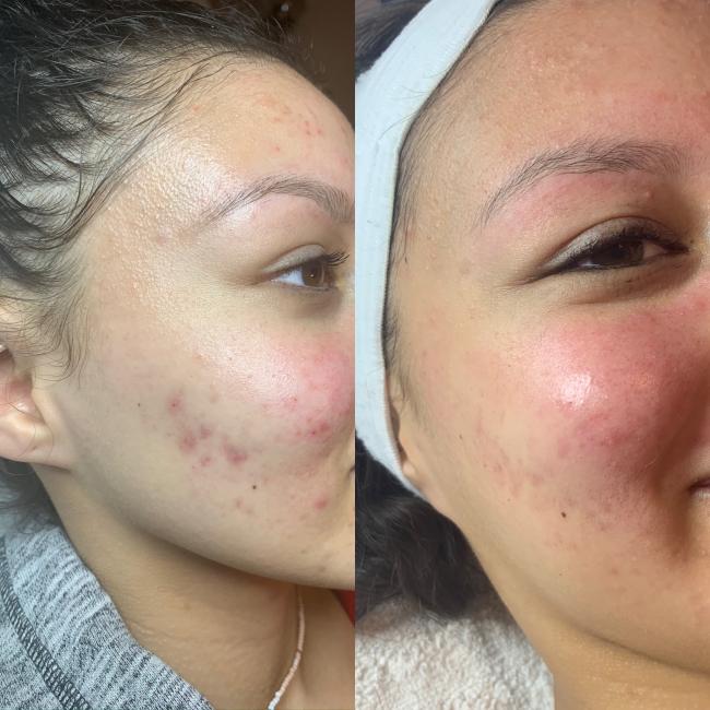 Before and After Acne Treatment