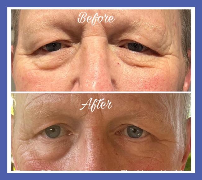 Lift and Tighten - non-surgical face lift, using radio frequency and Genie take ten