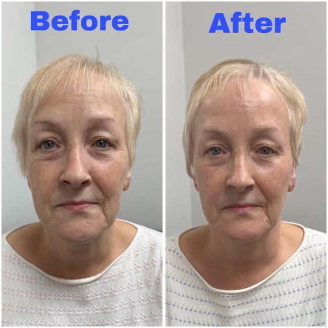 Skin Tightening Treatment, using radio frequency and Dermalux LED Light Therapyy
