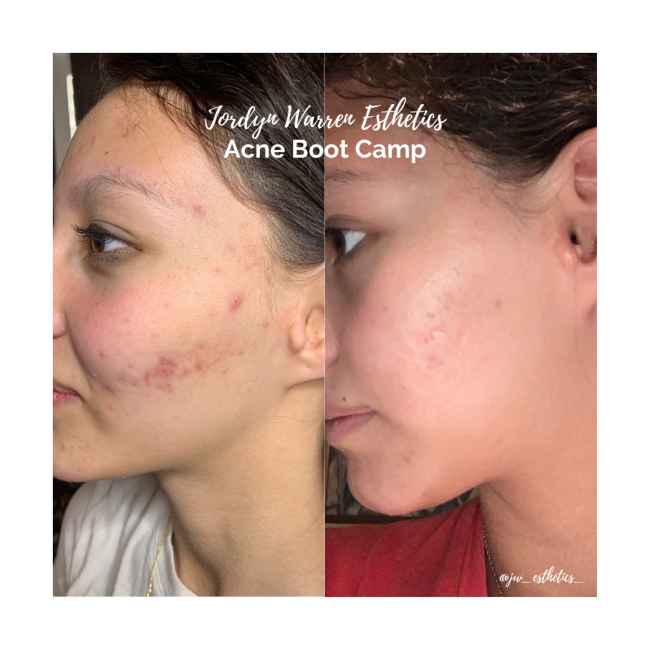Before and After Acne Treatment