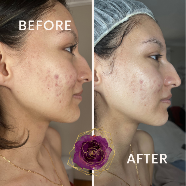 Before and After Acne Treatment