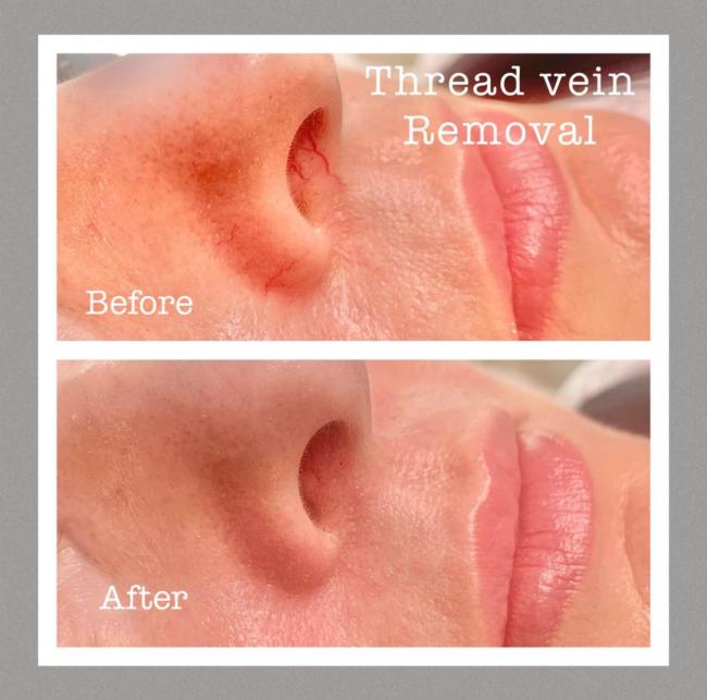 Thread vein treatment before and after