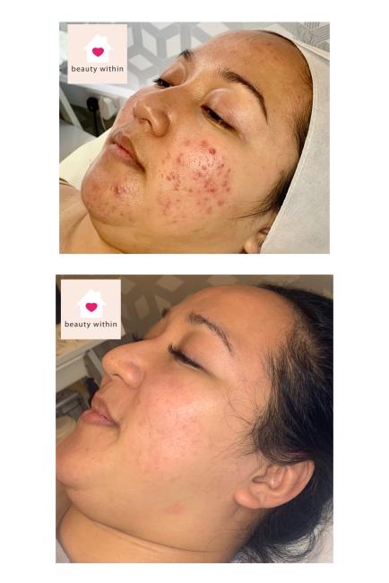 Skin peel results for acne skin