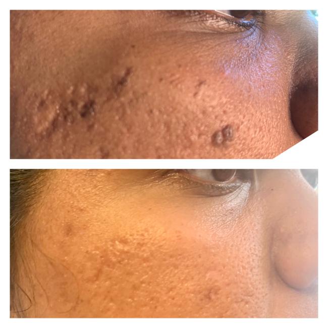 Advanced electrolysis treatment results for Dermatosis Papulosa Nigra