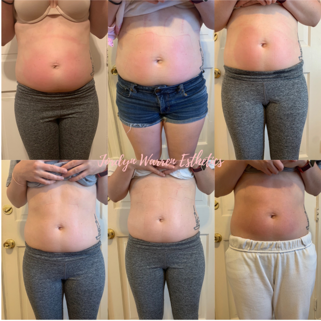 Before and After 10 Body Contour Sessions