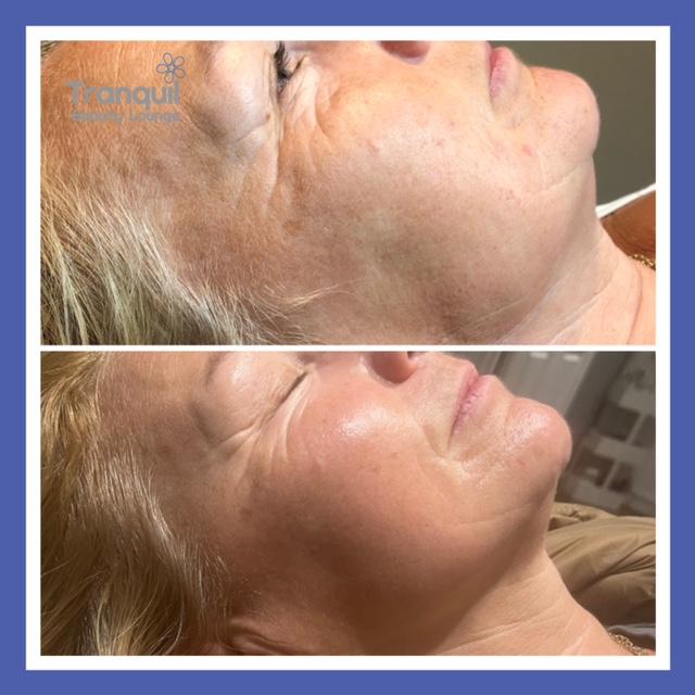 Lift and Tighten - non-surgical face lift, using radio frequency and Genie take ten