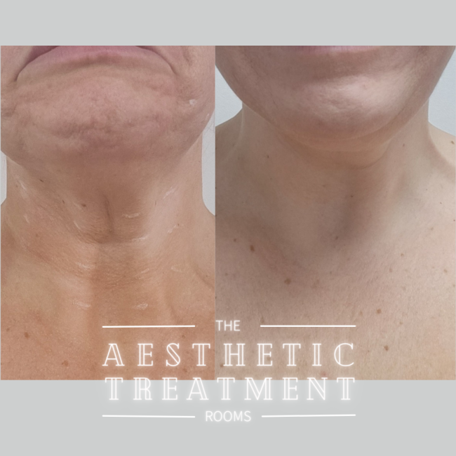 Improvement of the appearance of the neck bands that can cause turkey neck like appearance