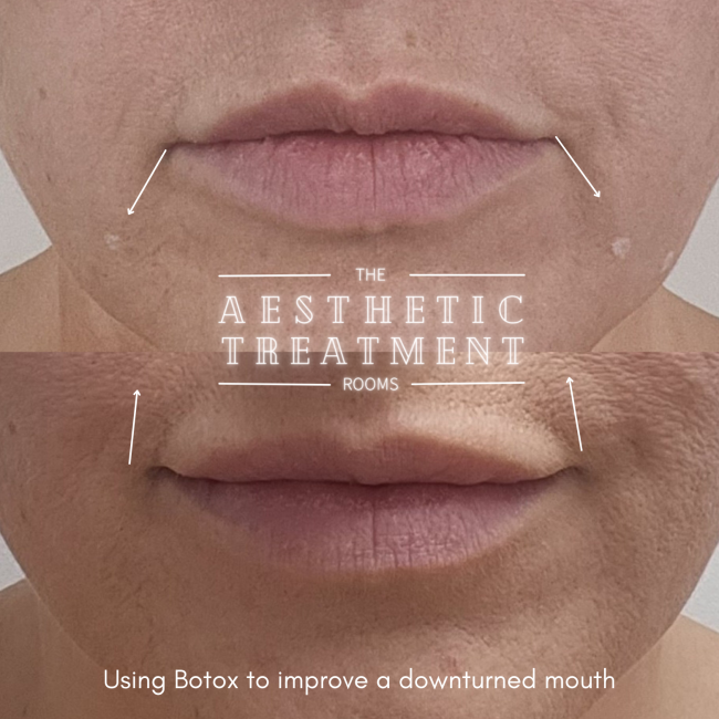 This treatment shows lifting of the corners of the mouth