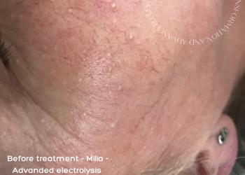 Multiple Milia Removal Before Treatment