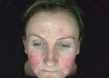 Acne Rosacea Before Transformation 