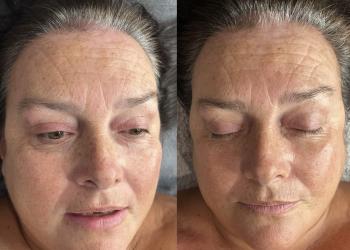 Before  after image of a course of menopausal skin treatment, reducing redness and irritation, and increasing hydration and collagen 