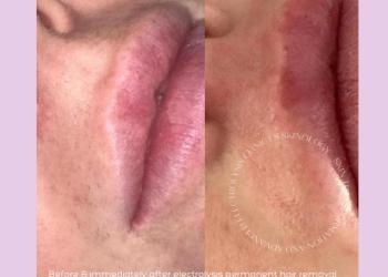 Electrolysis Lip Hair Removal 