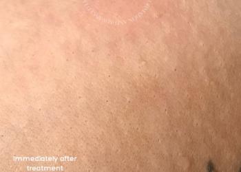 Skin Tag Removal Immediately After Treatment