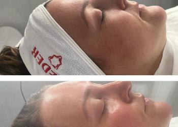 Before and after image of micro-needling treatment 