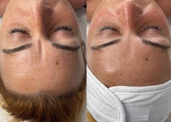 Before and after image of micro-needling 