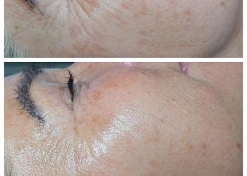 Before and after image of a course of micro-needling 