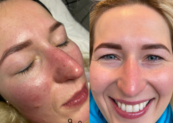 Rosacea Redness