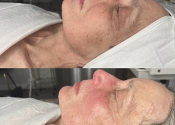 Before and after 3 needle free wrinkle reducing facials 