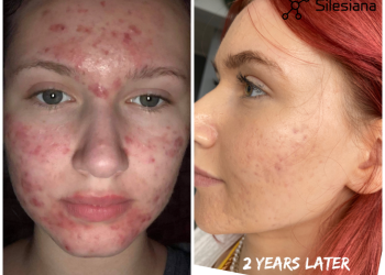 Acne Compromised Skin Scars