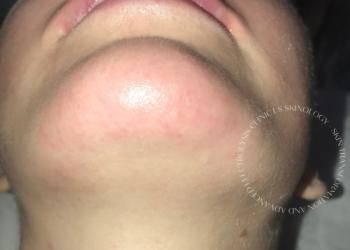 Electrolysis Chin Hair Removal Immediately After Treatment