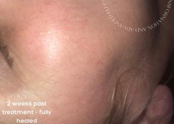 Milia Removal Fully Healed 2 weeks post treatment 