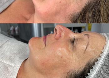 Before and after image of a course of Celluma LED light therapy 