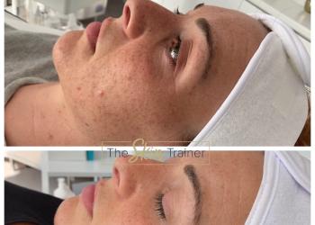 Before and after image of a course of Celluma LED light therapy 