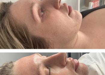 Before and after image of micro-needling 