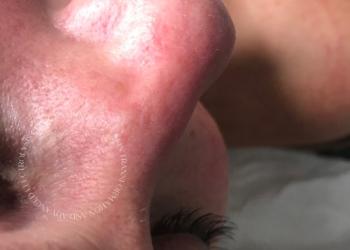 Milia Removal Immediately After Treatment