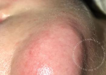 Electrolysis Chin Hair Removal Immediately After Treatment