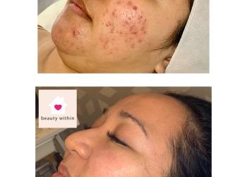 Results after skin peels