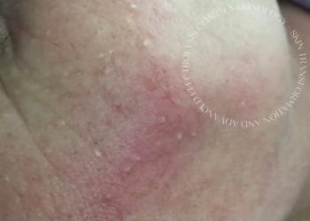 Milia Removal Immediately After Treatment