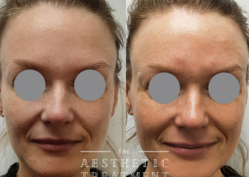 This shows results from using BioRePeel to improve skin appearance