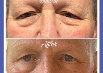 Lift and Tighten - non-surgical face lift, using radio frequency and Genie take ten