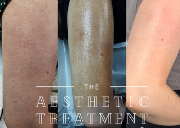 This image shows improvement of keratosis Pilaris using a chemical peel with microneedling