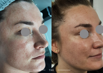 Showing the improved appearance and texture following a chemical peel