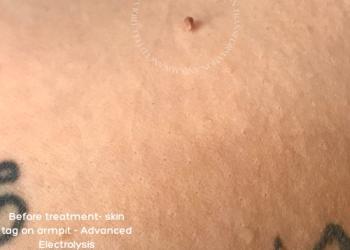 Skin Tag Removal Before 