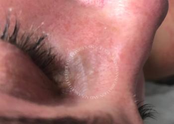 Milia Removal Before Treatment