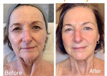 Results before and after Radiofrequency facials