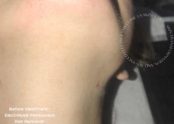 Electrolysis Chin Hair Removal Before Treatment 