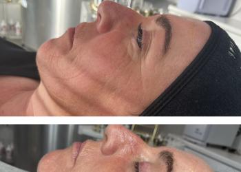 Before and after image of a course of micro-needling 