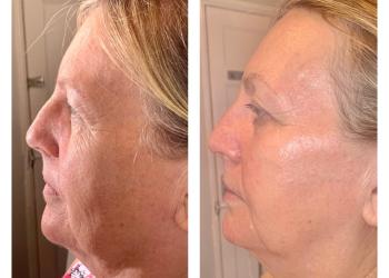 Results after Radiofrequency facials