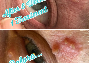 Fibroblast Mole Removal with PlasmaPen UK by Tracey