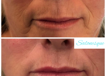 Lip Filler by Tracey