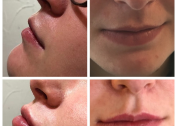 Lip Correction with Fillers by Tracey