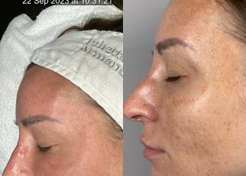 Melasma pigmentation