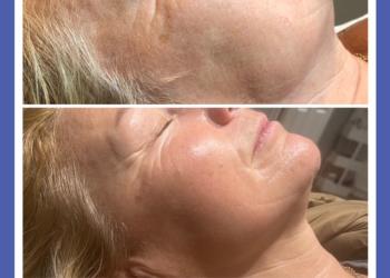 Lift and Tighten - non-surgical face lift, using radio frequency and Genie take ten
